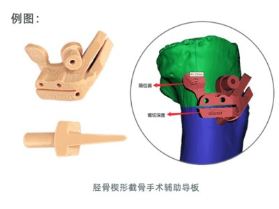 3D打印手术辅助导板图1