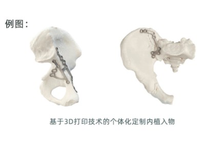 个体化定制辅助模型图1