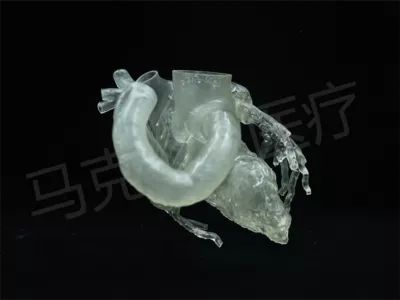冠状动脉瘘图1