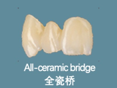 All-ceramic bridge 全瓷桥图1