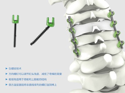 PCF 颈椎后路内固定系统图1